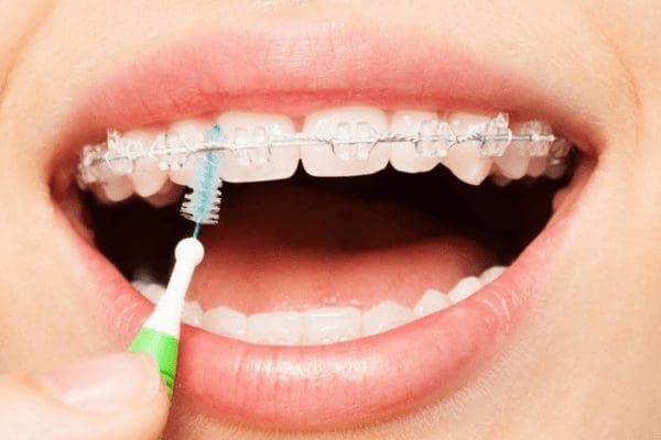 How To Care For Braces
