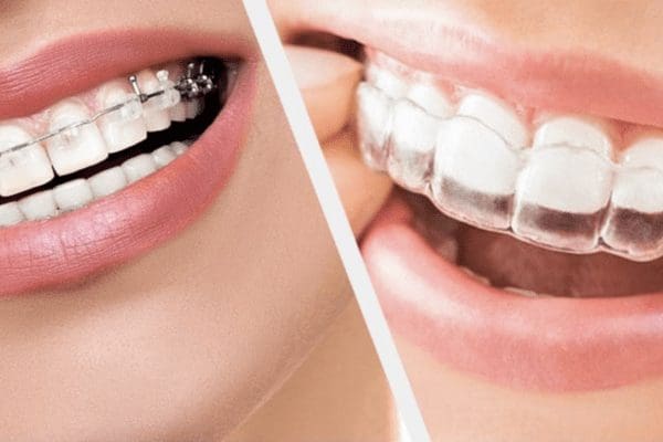 A Guide to Orthodontic Treatments