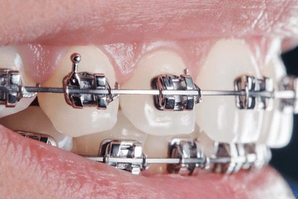 The Different Types of Braces for All Ages