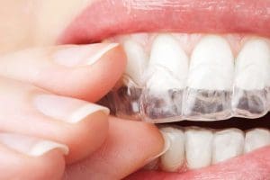 How Does Invisalign Work