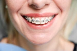 The Low Down on Damon Braces